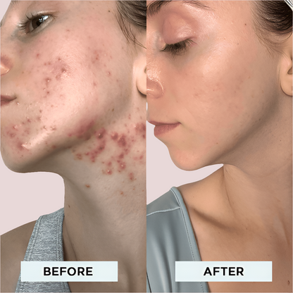 High Frequency Facial Magic Wand